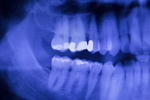 Dental teeth fillings